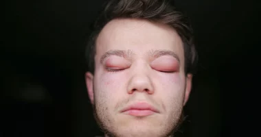 Angioedema