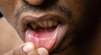 Mouth ulcer