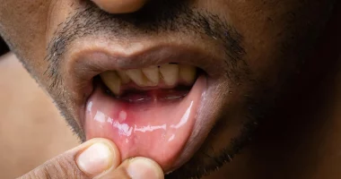 Mouth ulcer