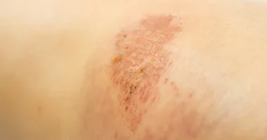 Bullae Diseases